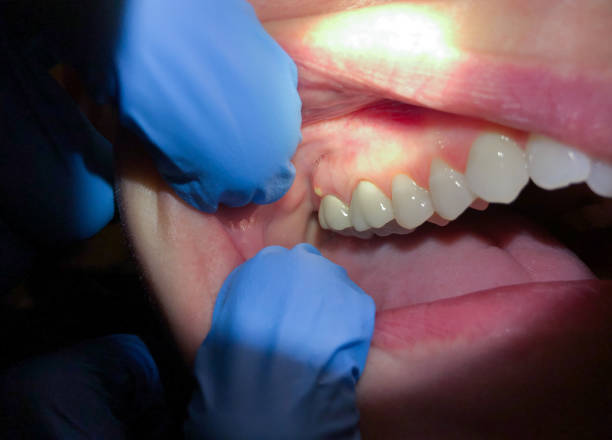 Best Emergency Treatment for Dental Infections or Abscesses in Heritage Pines, FL